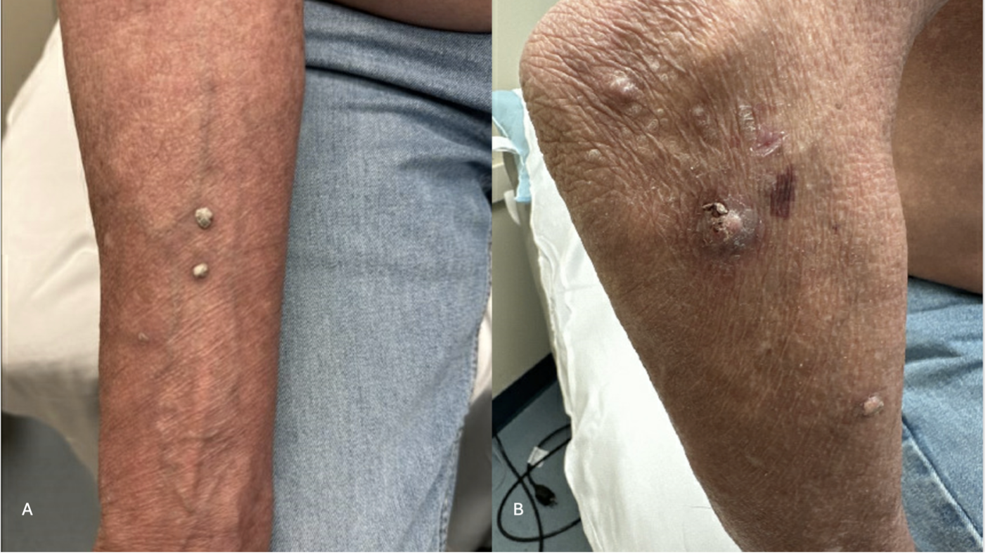 This image presents flesh to white-colored, firm verrucous papules of the right arm. (B) 