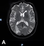 Initial brain MRI 