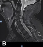 Sagittal view of thoracic and cervical MRI with prominent focus at the level of T4 