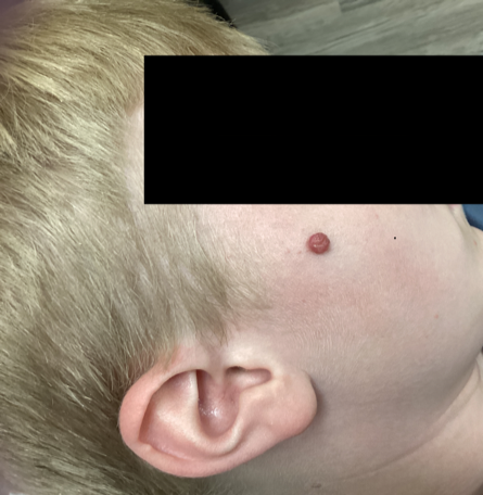 A 0.8 cm pink, dome-shaped papule with irregular borders on the right central zygoma