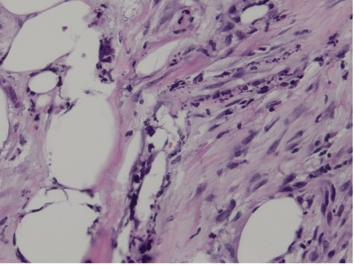 Figure 2. Calcification is noted in the walls of small blood vessels (Hematoxylin-eosin-stained sections; original magnification x400).
