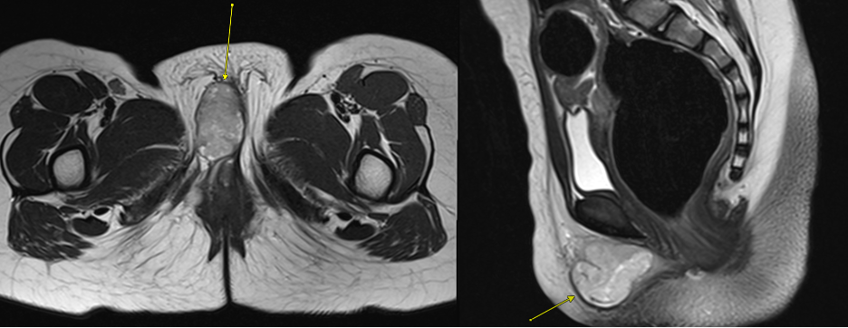 Pre-contrast axial T2-weighted MR image of the pelvis demonstrating a well-circumscribed, intermediate intensity lesion (arrow) within the right labia.