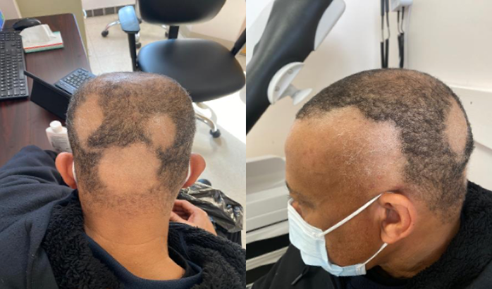 Several nonscarring alopecia patches at baseline.