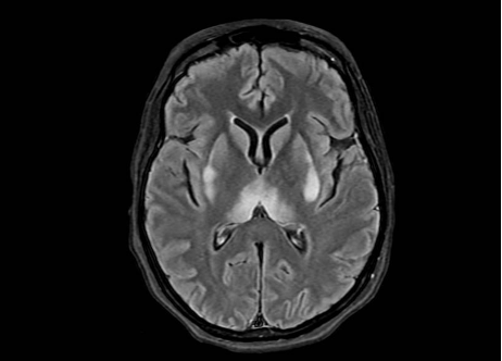 Figure 2. MRI Brain (with and w/o contrast) on day of initial admission before treatment. 