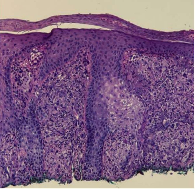 Biopsy of right nasal lesion demonstrating pseudocarcinomatous hyperplasia with noncaseating granulomas.