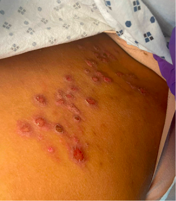 Discrete papulonodular lesions with superficial erosions in a grouped cluster on the lower back and upper buttocks.