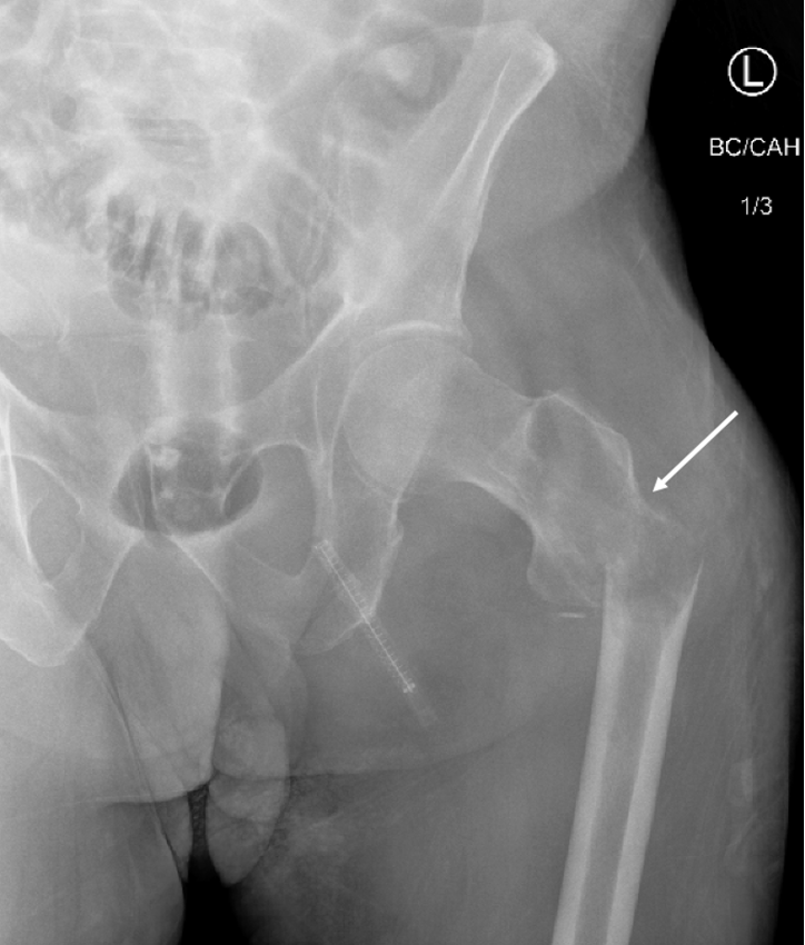 Plain radiograph of left proximal femur. Progression to displaced pathologic left subtrochanteric femur fracture with cortical destruction (white arrow). 
