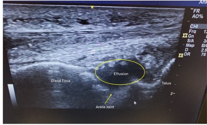 Figure 2. Long axis view of the ankle joint demonstrating effusion.