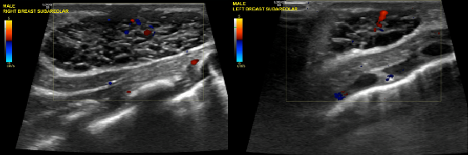 Figure 2A-B. Ultrasound images of the right (A) and left (B) breasts show circumscribed heterogeneous hypoechoic subareolar structures, right greater than left, with mild internal vascularity, consistent with physiologic neonatal gynecomastia and without evidence of abscess formation.