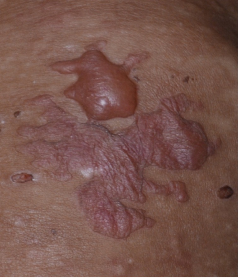 The blisters/bullae contain clear fluid initially but may become hemorrhagic with time.