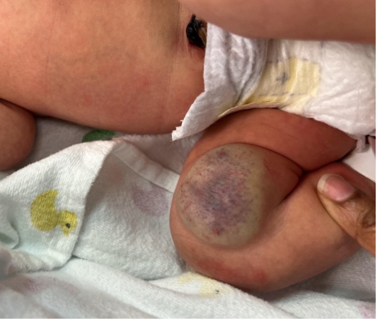 a clinical photograph of the infant’s lesion at 24 hours of life