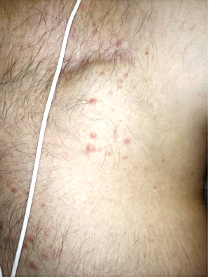 Figure 2. Pink papules overlying the patient’s pacemaker on his left chest.