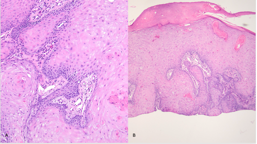 The specimen reveals keratinocytes with ample glassy cytoplasm extending into the dermis.