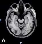Axial contrast-enhanced T1-weighted MRI 