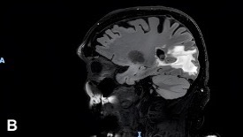 Sagittal T2-weighted FLAIR MRI 