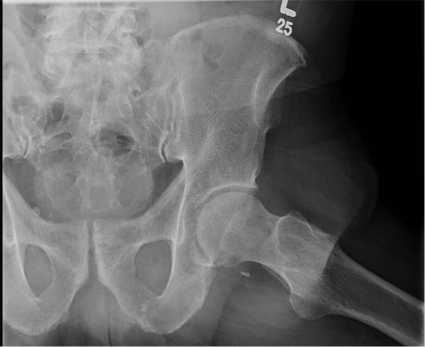 Figure 2. A lateral radiograph of the left hip is shown.