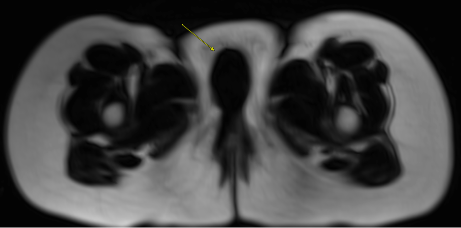 Pre-contrast axial T1-weighted Dixon "fat only" MR image demonstrating absence of fat signal within the right labial mass (arrow). 