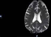 Post-treatment brain MRI 