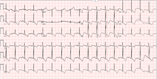Figure 3. Abnormal findings seen on electrocardiogram (ECG) completed on initial admission to the hospital. ECG significant for deep T-wave inversions on the inferior leads (II, III, avF) and the precordial leads (V1-V6). These cerebral T-waves lend credence to brain parenchymal injury and point the diagnosis more towards Wernicke’s encephalopathy.