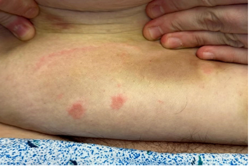 Figure 3. Rash seen on lower abdominal fold. 