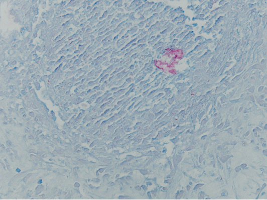 Figure 3. Acid-fast bacilli stain (original magnification ×400) identified mycobacteria within the dermis