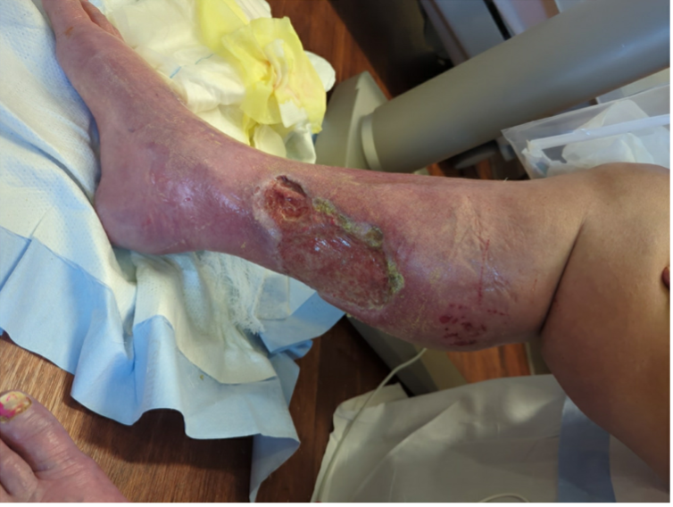 Figure 3. An image of the patient’s right lower extremity wounds at the time of admission is shown.
