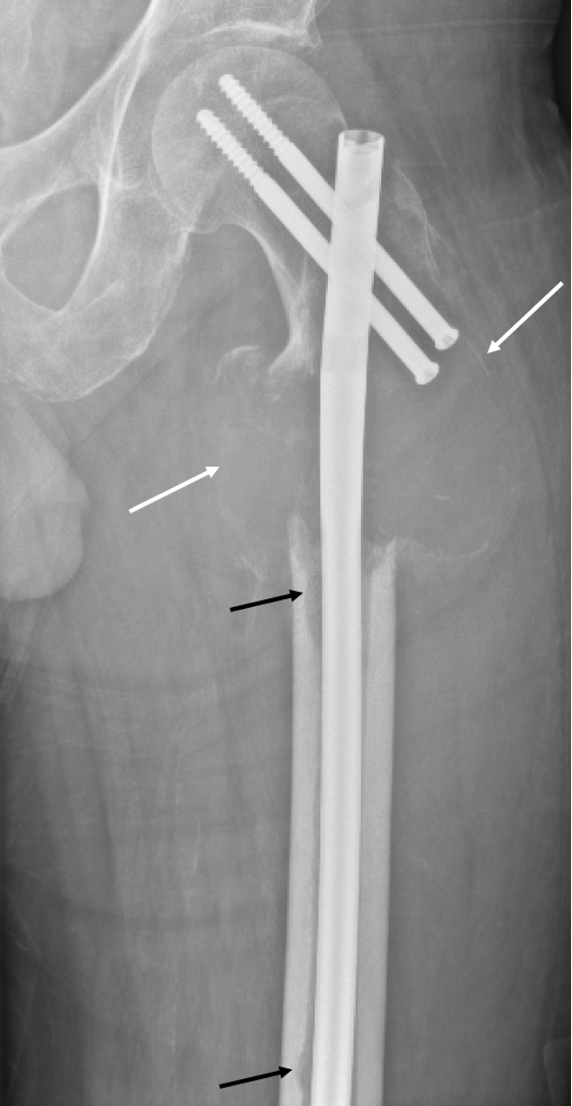 Plain radiograph of left proximal femur. 