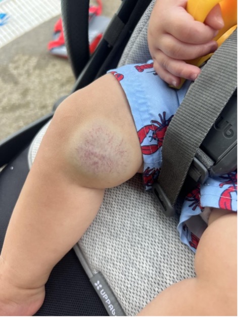 Figure 3. The RICH congenital hemangioma at 8 months of age, showing fading telangiectasia with decreased size of the lesion and blending with the surrounding skin.