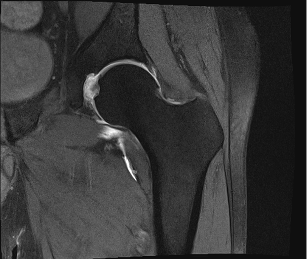 Figure 3. The Coronal T2 MRI with arthrogram is shown. 