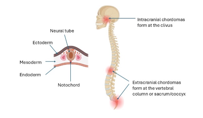 Chordomas are thought to arise from notochordal remnants (left
