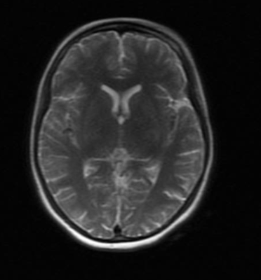 Figure 4. MRI Brain approximately 1 week after treatment with 400 mg IV thiamine TID. MRI Brain (with and without contrast) shows significantly improved restricted diffusion at the bilateral putamen, medial thalami, and substantia nigra. Abnormal enhancements are significantly reduced.