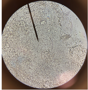 Figure 4. Diagnostic testing included a potassium hydroxide (KOH) stain