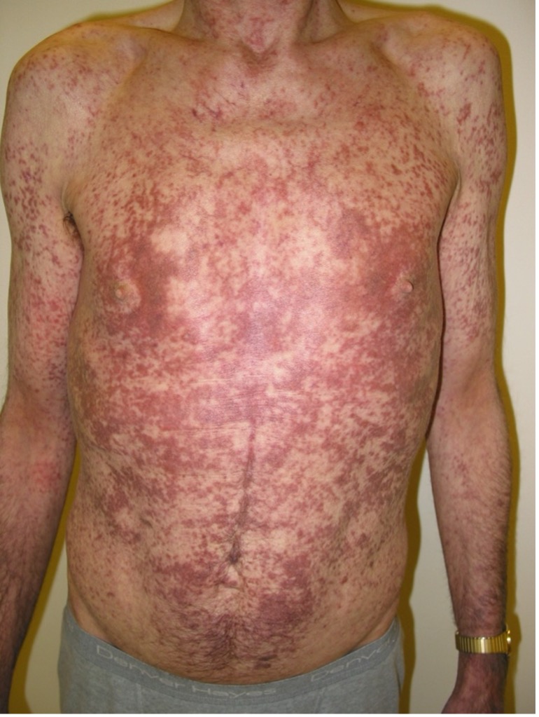 adult patient with DCM