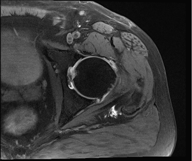 Figure 4. Axial T2 MRI of the hip with arthrogram is shown. 