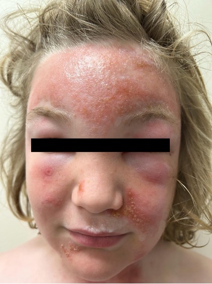 Pink, erythematous and edematous plaques with yellow to light brown exudate and crusts involving the forehead, bilateral cheeks and left periorbital skin.