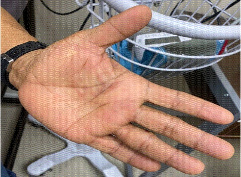 A smaller erythematous lesion with similar morphology is visible beneath the middle finger.