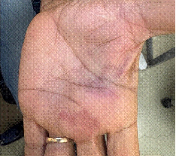 Two-week follow-up image of the left hand 