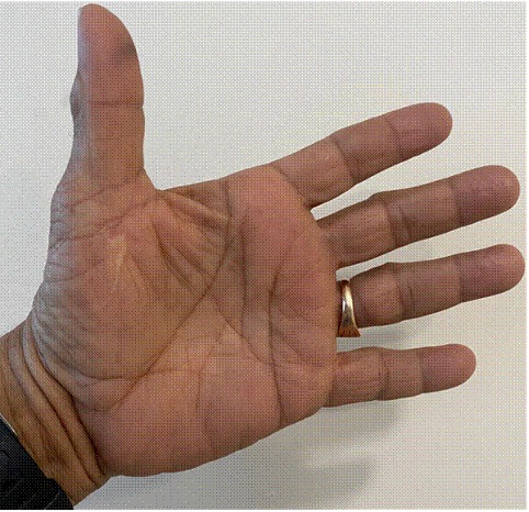 The palmar surface of the left hand 