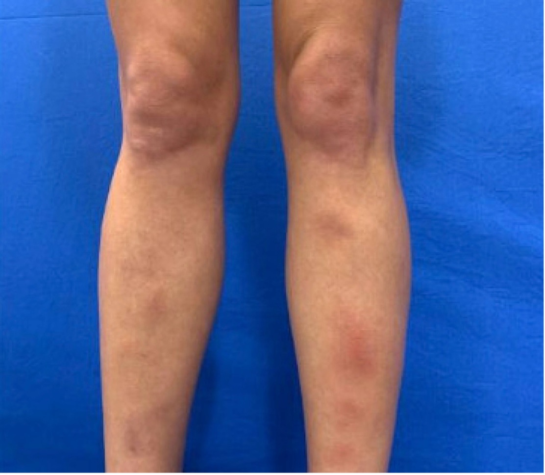 Fitzpatrick Skin Type III female with exquisitely tender, brownish-red, poorly demarcated, subcutaneous nodules on the bilateral anterior shins.