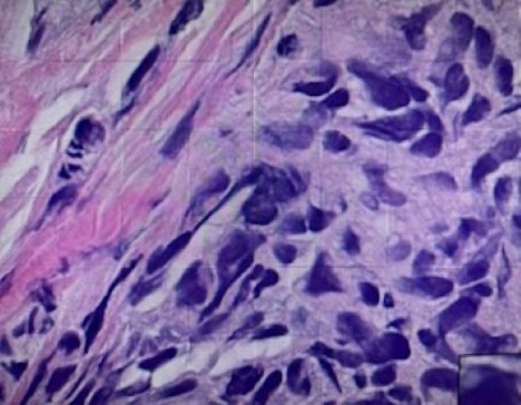 Sections of the resected intranasal lesion 