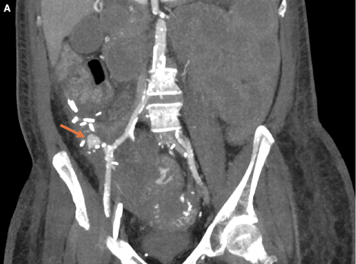 Figure 1. Thick multiplanar reformatted (MPR) coronal computed tomography (CT) in the arterial phase demonstrates a large pseudoaneurysm (arrow) arising from the pancreatic transplant arterial anastomosis.