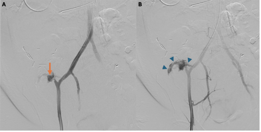 Figure 3. (A) Angiogram of the arterial conduit demonstrates the pseudoaneurysm (arrow). (B) A slightly delayed angiographic frame shows contrast extravasation (arrowheads) outlining the bowel lumen and confirming the presence of an arterio-enteric fistula.