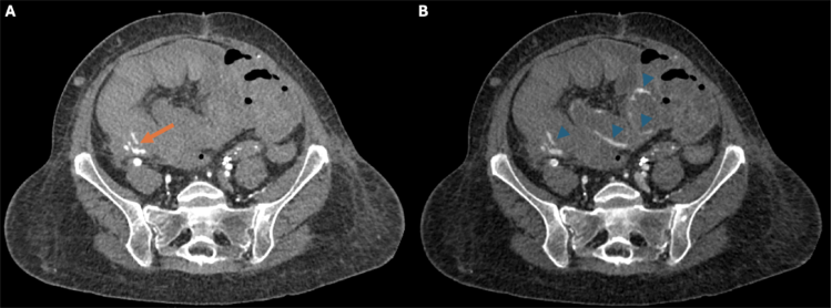 Figure 2. (A) Arterial phase axial image just inferior to the pseudoaneurysm shows active contrast extravasation (arrow) into a blood-filled right lower quadrant bowel loop. (B) Delayed image reveals pooling of contrast (arrowheads) as fresh blood surrounds hematoma filled loops of bowel.