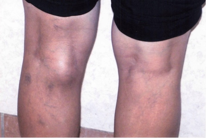 The cyst tends to be more evident when the patient is standing with full extension of the knee