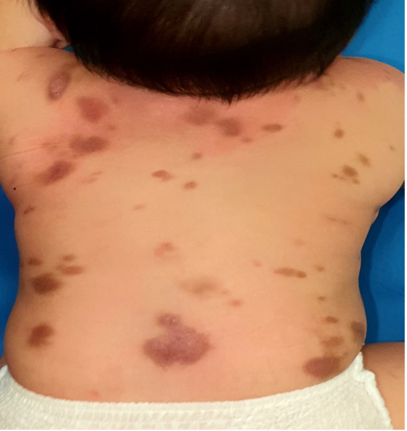 Lesions can be few (≥ 4) or numerous and are larger than those seen in the monomorphic variant.