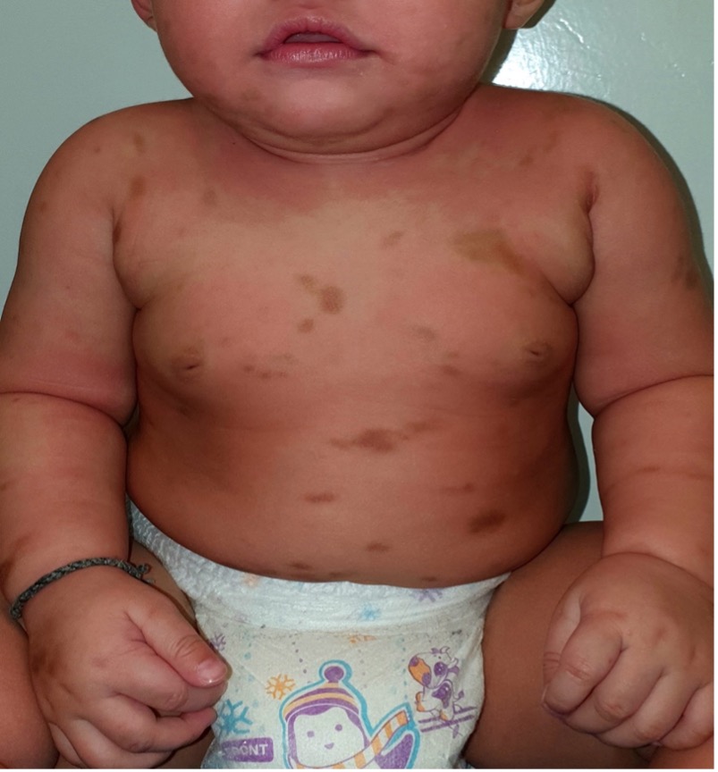 The polymorphic maculopapular cutaneous mastocytosis variant is generally seen in children.