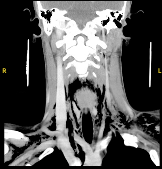 The patient’s soft tissue neck CT with contrast is shown.