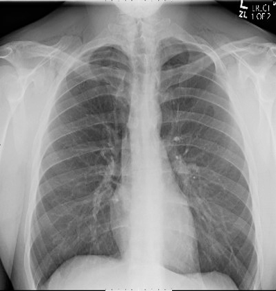 The patient’s anteroposterior chest x-ray is shown.