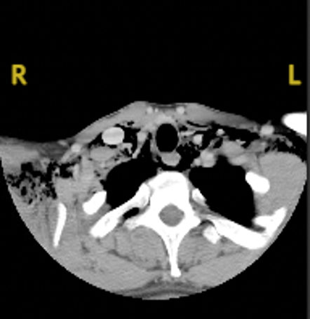 The patient’s neck CT with contrast is shown.