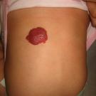 Infantile hemangioma